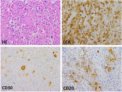 Transition Between Diffuse Large B-Cell Lymphoma and Classical Hodgkin Lymphoma– Our Histopathological and Clinical Experience With Patients With Intermediate Lymphoma